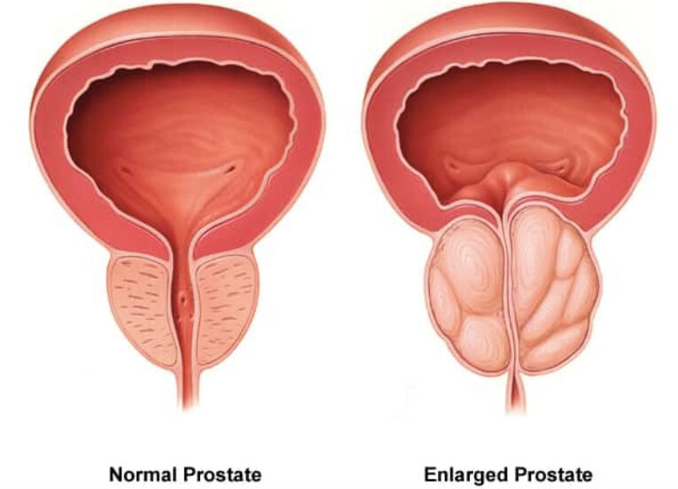 How to Shrink Prostrate